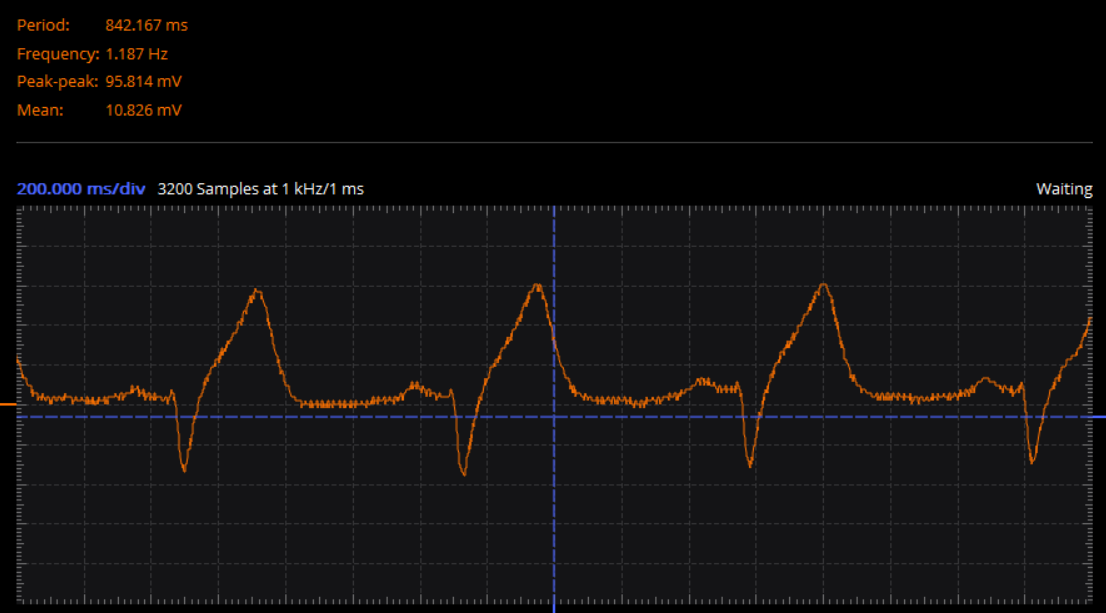 Electrocardiogram